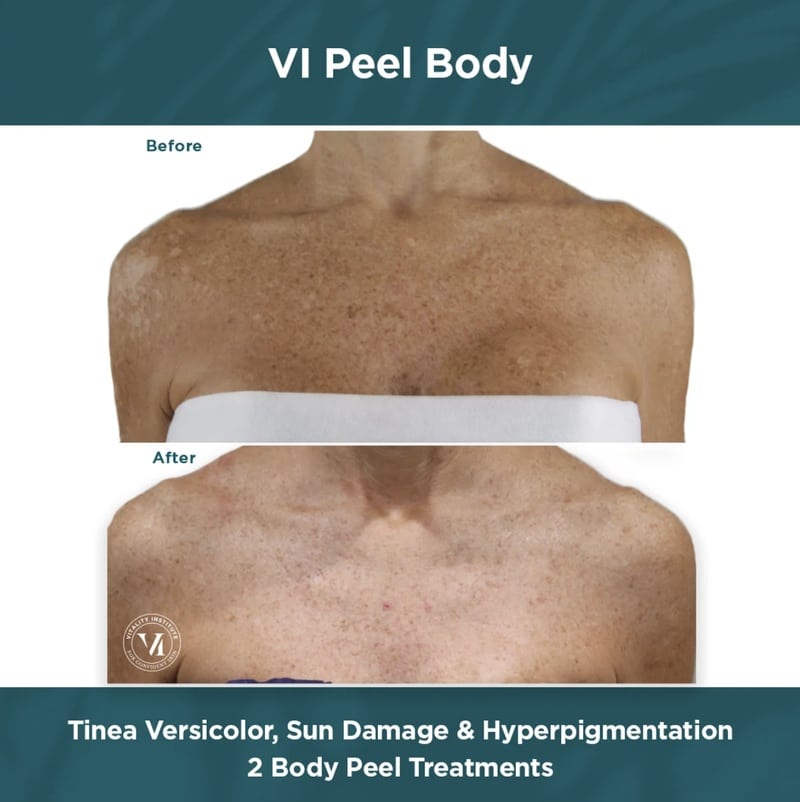 v1-peel-body-chemical-peel-before-after-front v1 peel body chemical peel before and after results on the front of a woman's body