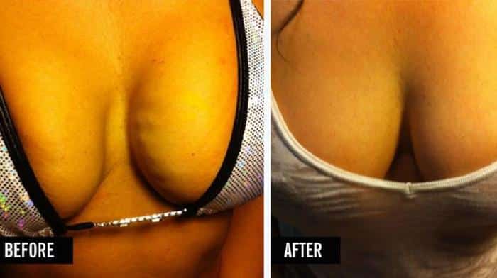 vampire-breast-lift-before-after-1 Before and after results of a vampire breast lift in naples and fort myers, fl