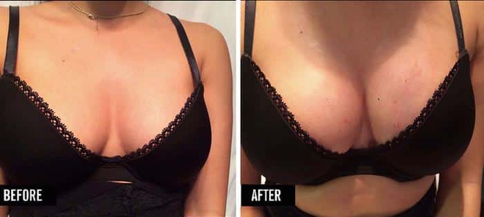 vampire-breast-lift-before-after-2 Before and after results of a vampire breast lift in fort myers and naples, fl