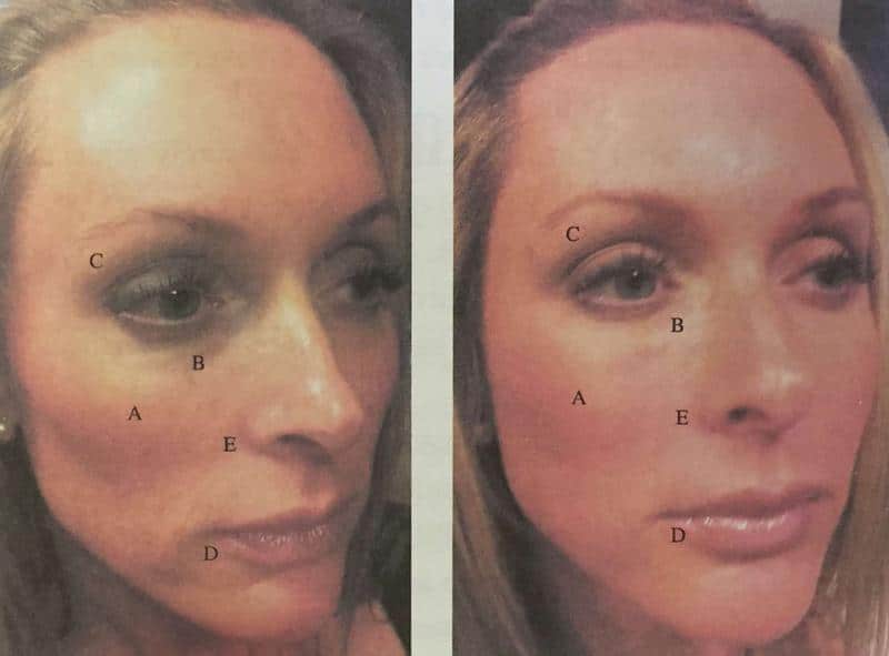 before and after results of vampire face lift in fort myers and naples, fl