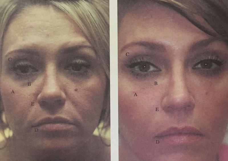 before and after results of vampire face lift in naples and fort myers, fl