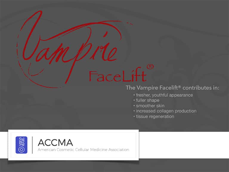 vampire face lift in fort myers and naples, fl