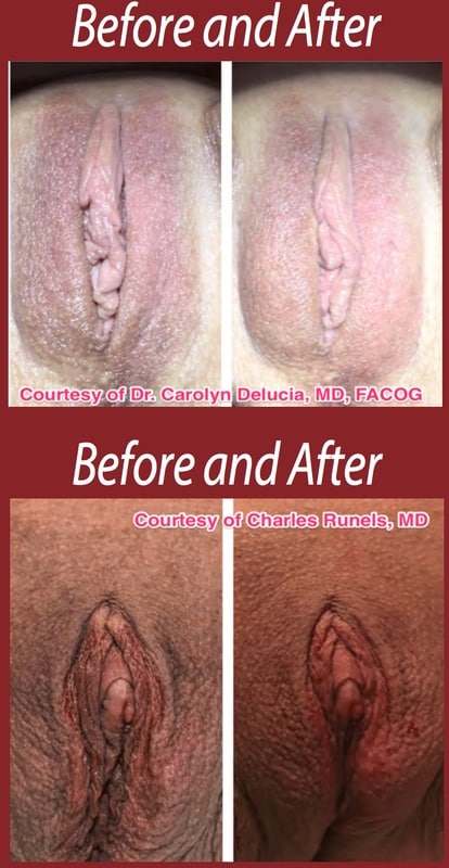 vampire-winglift-before-after-results vampire winglift before and after results in naples and fort myers, fl